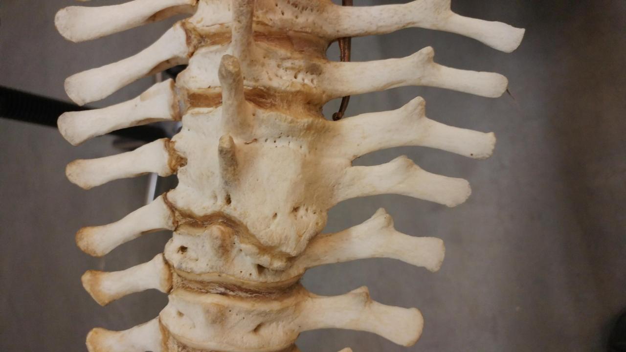 Totaal gefuseerde ruggenwervels